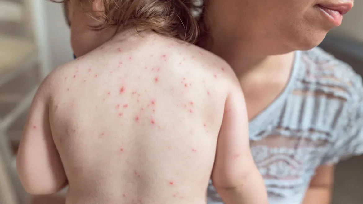 Heat Rash In Babies: गर्मियों में छोटे बच्चों को हीट रैश की समस्या हो सकती है; जानें लक्षण और बचाव कैसे करें