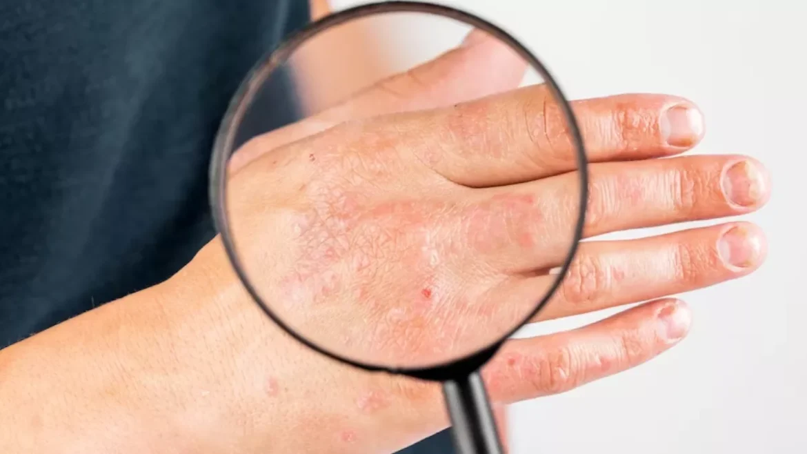 Home Remedies for Fungal Infection: स्किन फंगल इंफेक्शन से राहत पाने के घरेलू उपाय – जानें लक्षण, कारण और बचाव के तरीके