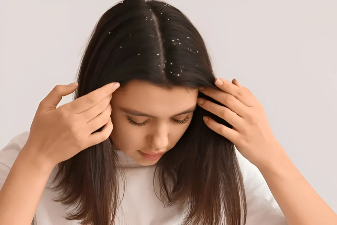 Winter Hair Care: सर्दियों में डैंड्रफ की समस्या से बचने के लिए इन 10 गलतियों से बचें